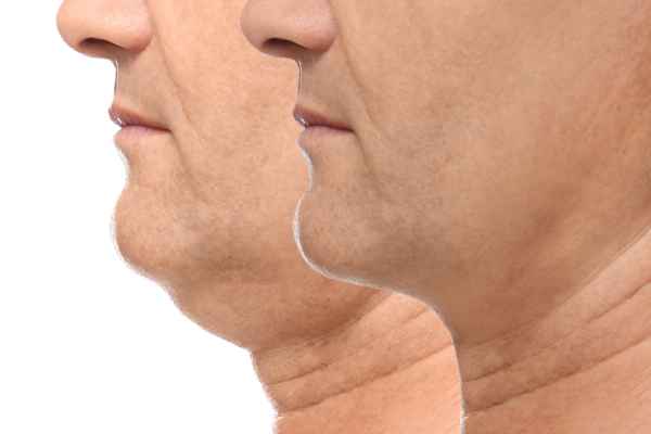 HIFU - Breakthrough in Anti - ageing 2 hifu results Cheshire