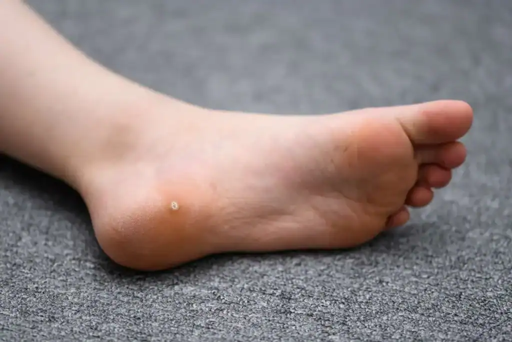 Cryotherapy For Warts And Also Verrucas 2 Image of verruca on the bottom of the foot that able to be treated with Cryotherapy Cheshire