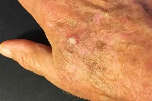Image of Actinic keratoses Cheshire on a person hand