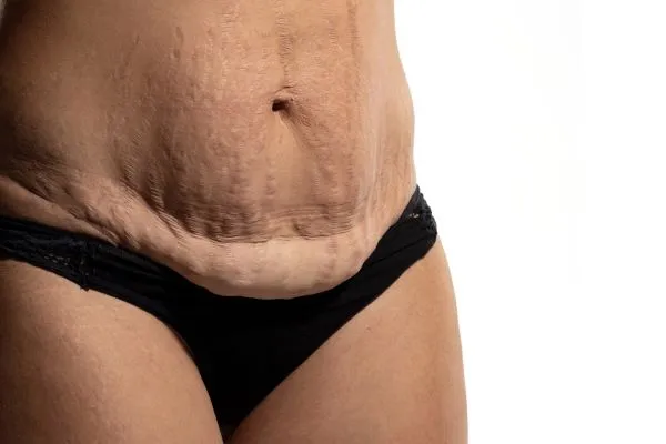 The Science of Skin Tightening 1 The science behind skin tightening Cheshire picture of a woman's sagging skin on the stomach